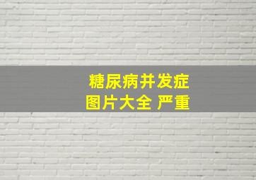 糖尿病并发症图片大全 严重